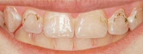 поверхневий карієс молочних зубів