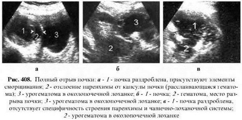 як лікувати розрив нирки