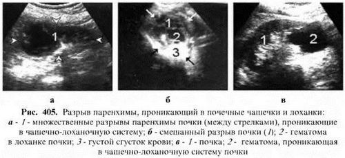 як лікувати розрив нирки