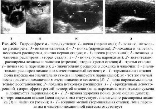 як лікувати розрив нирки