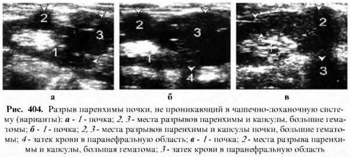 як лікувати розрив нирки