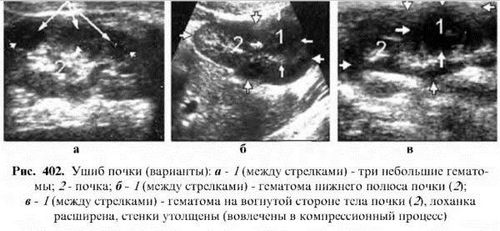 як лікувати розрив нирки