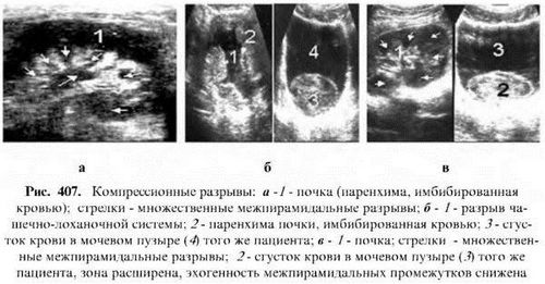 як лікувати розрив нирки