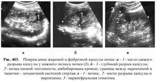 як лікувати розрив нирки