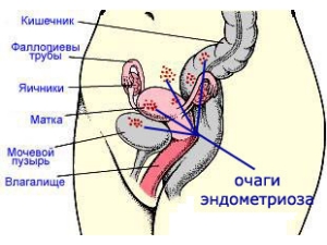 як вилікувати ендометріоз домашніми засобами