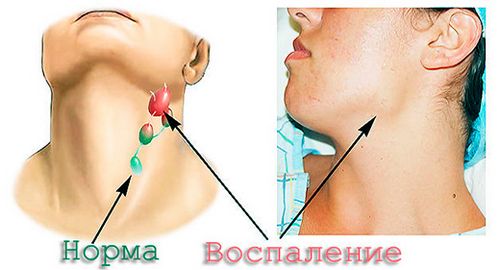 як лікувати лімфовузли на спині