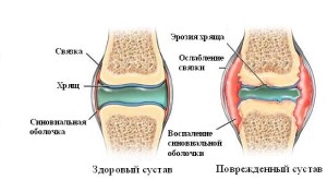 як лікувати псоріаз кистей рук