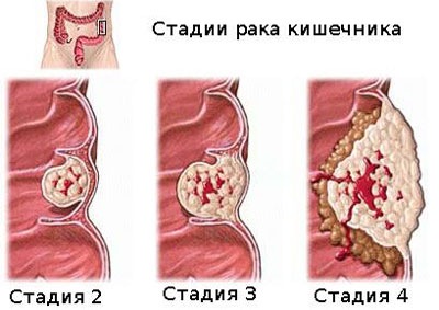 як лікувати рак дванадцятипалої кишки