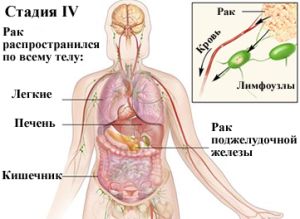 як вилікувати рак 4 стадії з метастазами