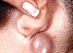 симптоми раку лімфовузлів на шиї