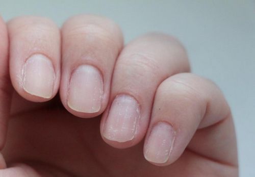 як лікувати розшарування нігтів