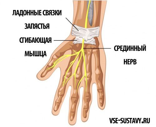 як лікувати розтягнення зап'ястя