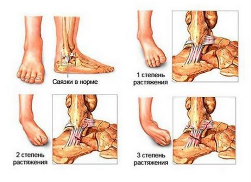 як лікувати розтягнення голеностопа в домашніх умовах