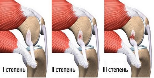 хрестоподібна зв'язка травма коліна розрив ПКС причини симптоми лікування запалення