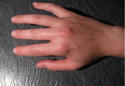 як лікувати ревматизм рук