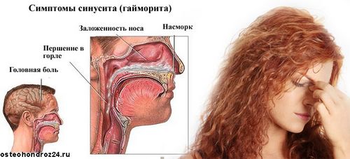 синусит лікування у дорослих симптоми ознаки хронічного