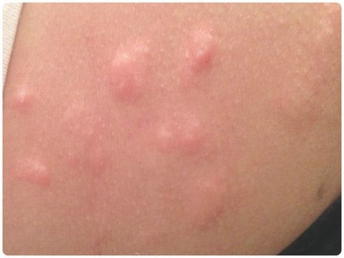 висип на шиї у дитини причини плечі як мурашки ентеровірусна вірусна герпетична пузврьковая на антибіотики кашель червона дрібна