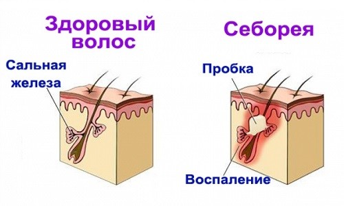 як лікувати змішану себорею