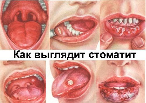 як лікувати лімфовузли в роті