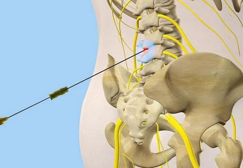 ніж лікувати радикуліт уколи