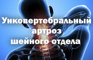 як лікувати артроз шийного відділу хребта