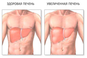 збільшена печінка