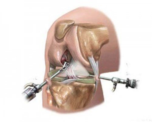 як лікувати медіальний меніск