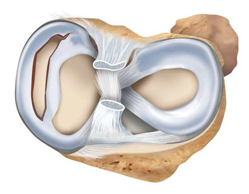 як лікувати медіальний меніск