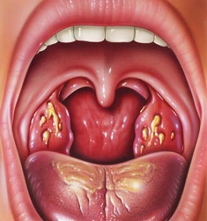 як лікувати хламідіоз горла