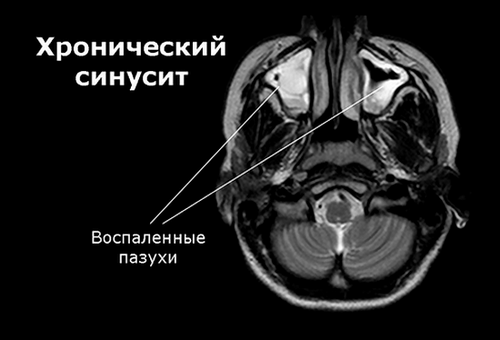 як лікувати латентний синусит