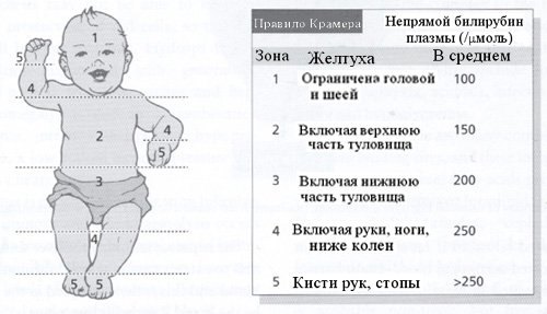 як лікують жовтяницю в пологовому будинку