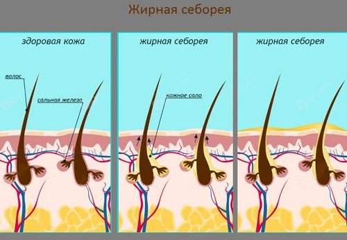 жирна себорея шкіри голови