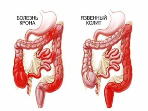 як лікувати печіння в кишечнику