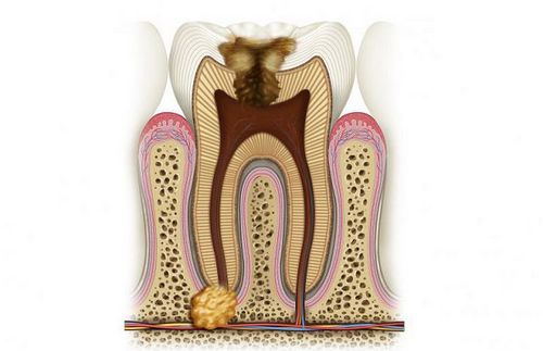 як лікувати кісту в зубі