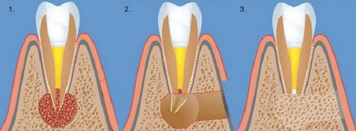 як лікувати кісту в зубі
